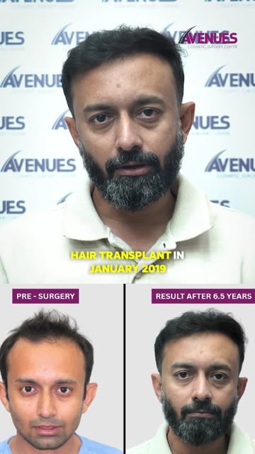 3000 Grafts | Hair Transplant Result

A look at this 3000 grafts FUE hair transplant result after 6.