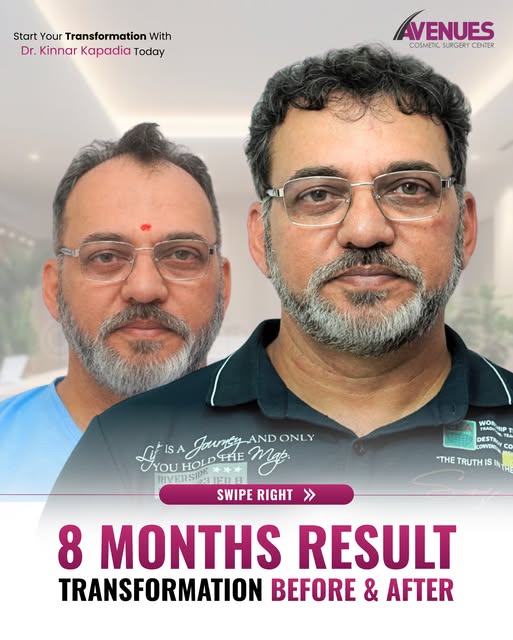 Hair Transplant Result | 8 Months After 3,000 Grafts

Hair loss can slowly change the way you see yo