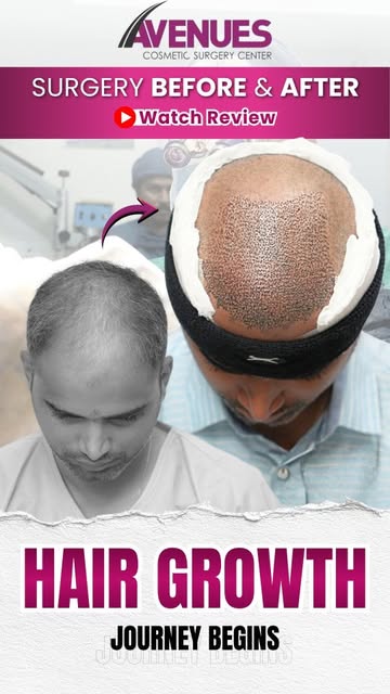 🔥 This Is Where The Hairline Changes 🔥

The change starts with the surgical plan. This hair transp