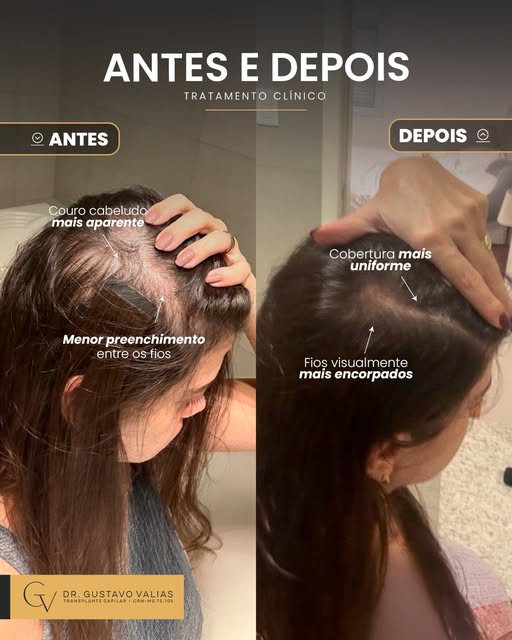 Quando o cabelo começa a perder densidade, o impacto vai muito além da aparência. O couro cabeludo c