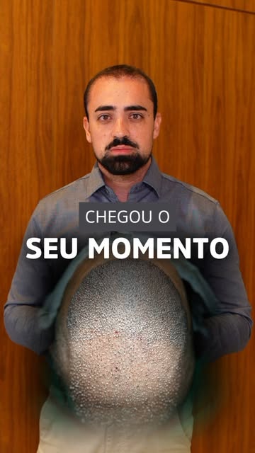 Transplante capilar não é apenas sobre recuperar fios. É sobre planejamento.

Antes de decidir pelo 