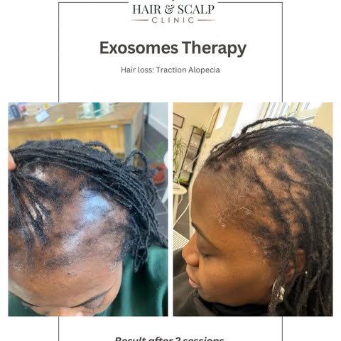 Before ➝ Progress 
Consistent care. Advanced technology. Healthier follicles.

Traction alopecia is 