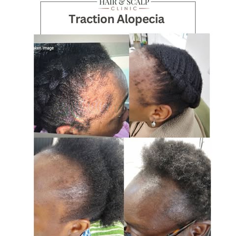 Traction Alopecia: What Your Hairline Is Trying to Tell You?

Traction alopecia is hair loss caused 