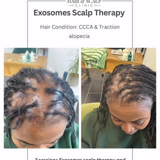 ✨ Progress in CCCA is Possible ✨
At 360 Hair & Scalp, we treat more than hair loss —
we treat the sc