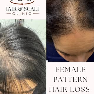 Female Pattern Hair Loss (FPHL) is common and often misunderstood. 

FPHL is a progressive thinning 