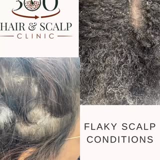 Flaky Scalp? Let’s Talk About It.
Flakes on the scalp are very common — but not all flakes are the s