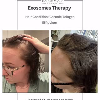 After months of excessive shedding, thinning, and stress around hair loss, seeing this transformatio