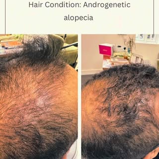 JetPeel delivers growth factors and nutrients deep into the scalp without needles, while PRP harness