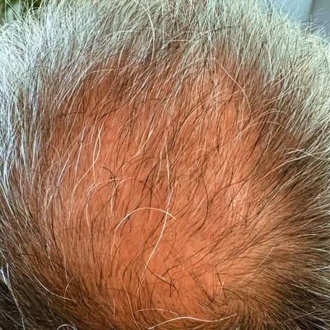 The results speak for themselves. 👏
This is the power of combining a hair transplant with carefully