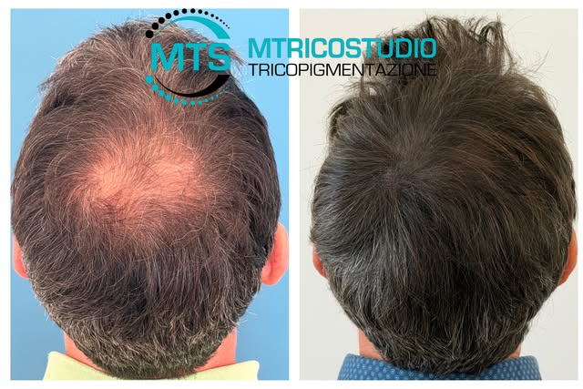 Non da nuovi capelli.
Ma può cambiare completamente la percezione di una zona diradata, riducendo il