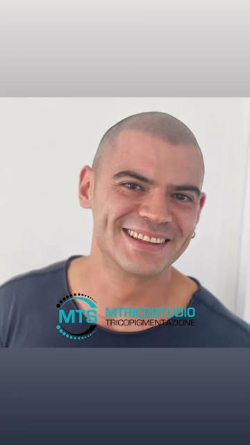 #Tricopigmentazione  #smp  #capelli  #capelliuomo  #effettorasato