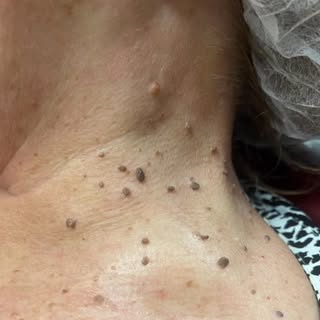 Multiple skin lesions (30+) removed with minimal downtime and quick healing. Before/ After to come !