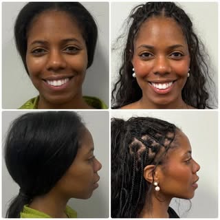 Check out these Amazing results! 
✨✨

Procedure: Chin Implant/Genioplasty

Goal: Enhance recessed or