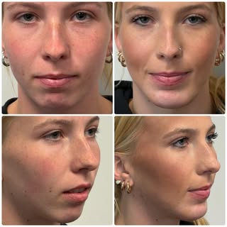 A stronger chin can completely transform facial balance and profile definition. ✨

This larger chin 