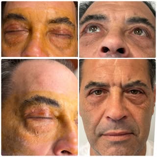 Check out these results! 
✨✨

Procedure: lower blepharoplasty

Appointments:
☎️ (610)668-3300