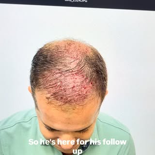 ✨Today my patient came in for his 1 year follow up. His results are fantastic. This patient had 2500
