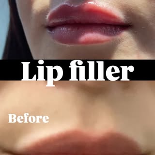 ✨ **Subtle change, beautiful definition.**
Lip filler designed to enhance your natural shape, add ba