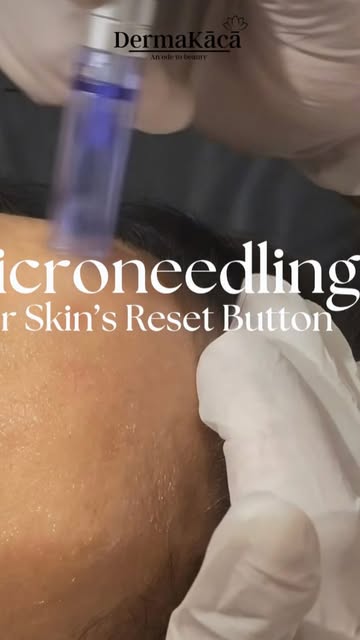 Glowing, healthy skin starts under the surface! ✨
Microneedling boosts natural collagen to smooth te