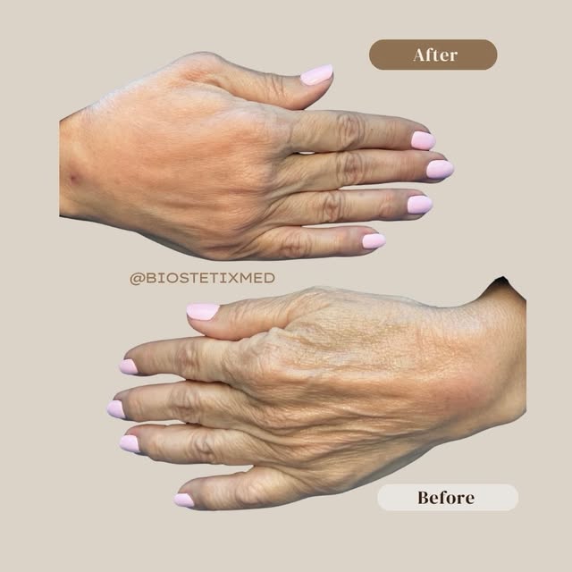 Your hands deserve a little rejuvenation. 😉✨

Smoother, fuller, younger-looking hands, because your