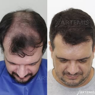 Nossas mudanças sempre incríveis ❤️🤞🏻#cabelo #fue #sp #satisfying #medicina #bearded#transplanteca