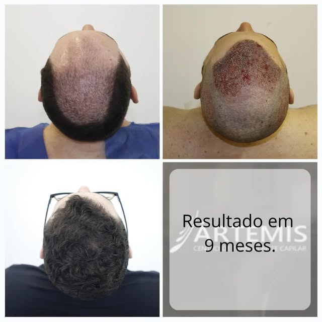 Crescimento com densidade pós 9 meses de cirurgia.

Nossa equipe é experiente e treinada para poder 