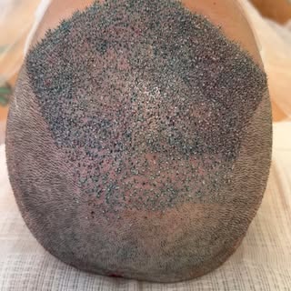 Reconstrução frontal total #cabelo #fue #sp #satisfying #medicina #bearded#transplantecapilar #cabel