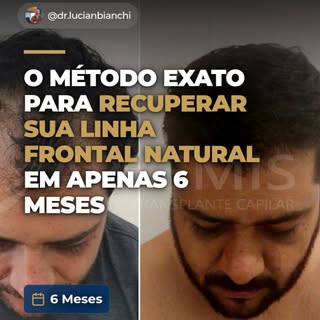 Você já sentiu que a sua testa está “ganhando espaço” no espelho a cada ano que passa? 🤨

Essa é um