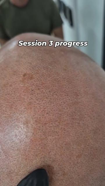 Realistic looking scalp micro takes time. 

You can't do this style of work in just 2 or 3 sessions.
