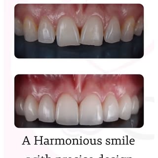 ‎ابتسامة طبيعية بتفاصيل مثالية ✨
احجز موعدك الآن مع اخصائي تركيبات الأسنان 

A natural smile with pe