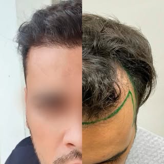O transplante capilar é uma jornada de recuperação da autoconfiança e satisfação pessoal. Ver um pac