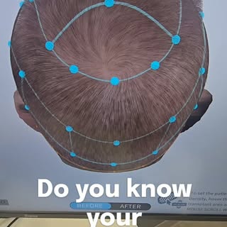 What could your hair look like in the future? 👀

Hair loss doesn’t happen overnight, and by the tim