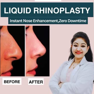 Instant Nose Correction with No Surgery! ✨
Witness the magic of LIQUID RHINOPLASTY – a quick, non-su
