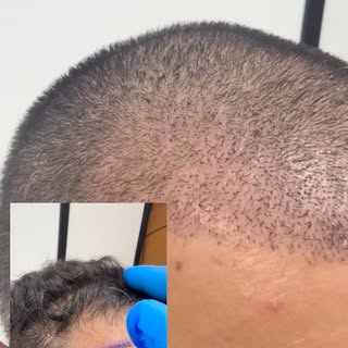 10 days post op >2500 grafts frontal restoration! The donor area appears impeccable! This will look 
