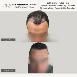 12 month Hair Transplant result. 3,000 Grafts | ~7000 Hairs. Will share the journey in the coming po