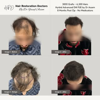 Incredible 8 month surgical only growth result, no medication. Scroll & enjoy all angles. 

3,000 Gr