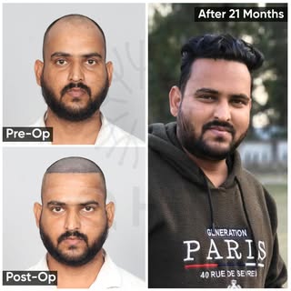 ✨ Norwood Grade 4 | 21 Months Hair Transplant Transformation ✨

Take a look at the incredible 21-mon