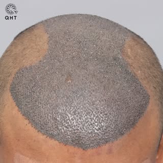 Diffuse Grade 4 | 4800 Grafts | Just After Surgery ✨

A new hair journey, crafted with precision and