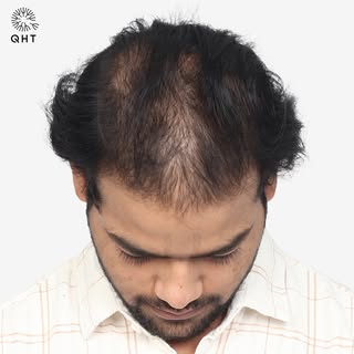 ✨ Diffuse Grade 4 | 7 Months Hair Transplant Transformation ✨

Take a look at the remarkable 7-month