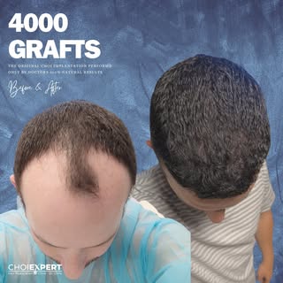 Amazing transformation through our hair restoration procedure:
-Graft Amount: 4000
-Method: Direct F