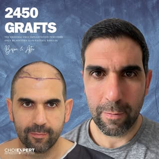 Amazing transformation through our hair restoration procedure:
-Graft Amount: 2466
-Method: Direct i