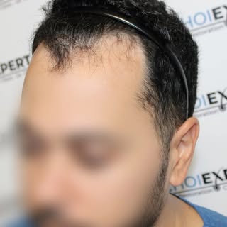 6 months after a frontal hair transplant.

At this stage, the transformation is already visible.

Th