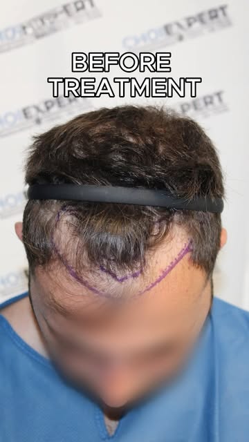 One year after a frontal hair transplant.

These photos were sent by the patient himself, showing th