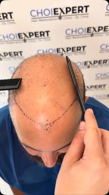 7,000 grafts. A new beginning. 🔥

Turned away by multiple clinics, this patient saw his dream of a 