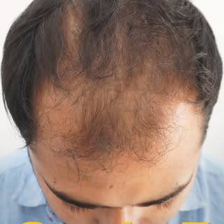 From Grade 7 Baldness to a Confident New Look ✨

Advanced Hair Transplant at Calcutta Cosmo Aid, Kol