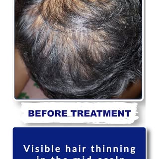 ✨ GFC Hair Treatment Result – Before & After ✨

Witness the transformation! 🌟 Our patient achieved 