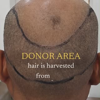 🧑‍⚕️ Hair Transplant Mein Hairline Marking Kyu Itni Zaroori Hoti Hai?

Grade 7 Baldness ke cases me