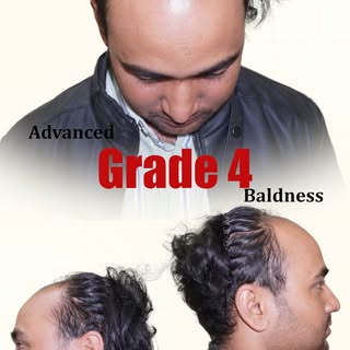 Thinking about a hair transplant? Restore your confidence with natural-looking results using the Adv