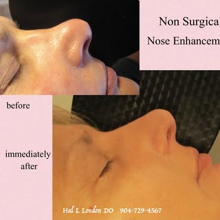 NON-SURGICAL NOSE ENHANCEMENT 6-23-26 - Dr. Hal London 

Another example of what can be done for the
