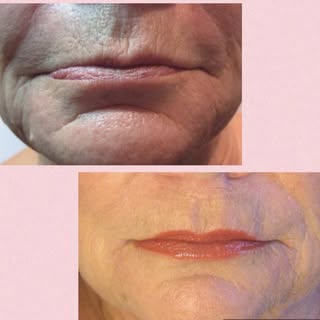 LOWER FACE ENHANCEMENT- Dr. Hal London

The lower face ages in predictable patterns. Understanding w