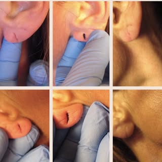 TORN OR STRETCHED EARLOBES- Dr. Hal London 

Easy 30 minute treatment fixes earlobes with stretched 